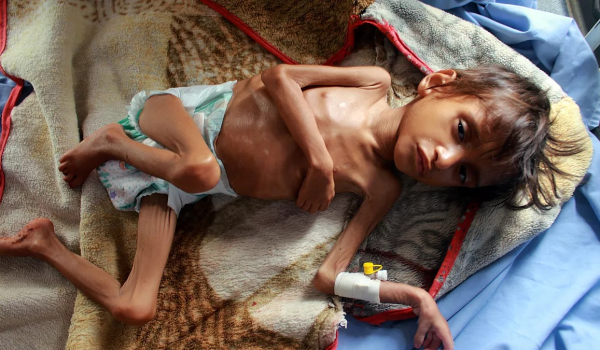 بسبب المجاعة: وفاة طفل بمستشفى كمال عدوان ما يرفع الحصيلة إلى 30...